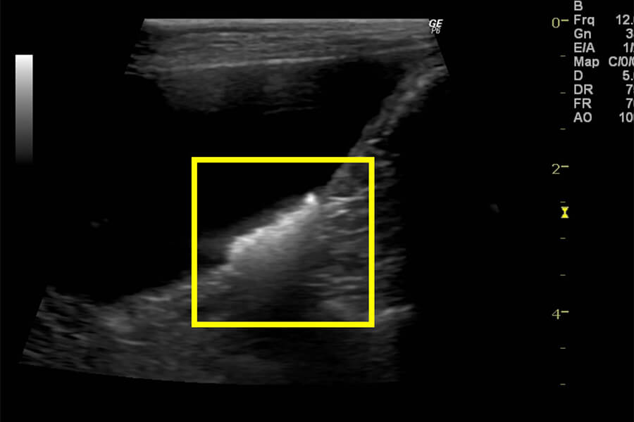 膀胱結石 エコー