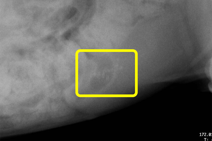 膀胱結石 レントゲン
