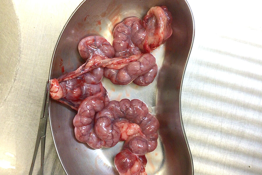 子宮内に貯留した膿